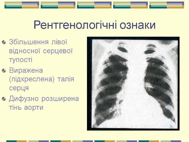 Рентгенологічні ознаки Збільшення лівої відносної серцевої тупості Виражена (підкреслена) талія серця Дифузно розширена тінь